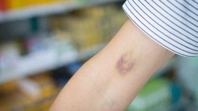 Hematomas sem motivo aparente pode ser sinal de alguma dessas