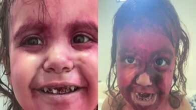 Menina De 3 Anos Surge Roxa, Deixa Os Pais Desesperados E Desfecho Vem à Tona