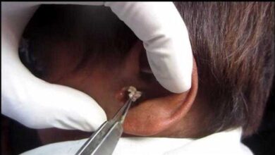 O ouvido desse menino está lhe matando de dor. O que encontraram é NOJENTO!