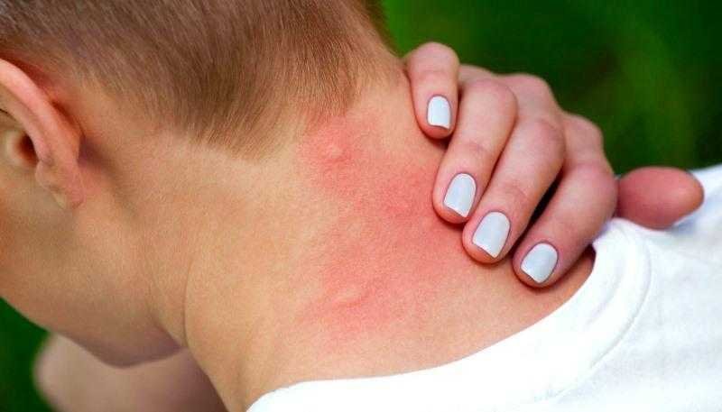 Por que os mosquitos picam mais umas pessoas que outras Por que os mosquitos picam mais umas pessoas que outras