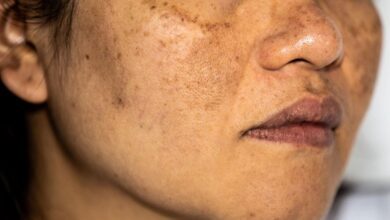 Receita caseira ELIMINAR manchas indesejaveis na pele Receita caseira ELIMINAR manchas indesejáveis na pele