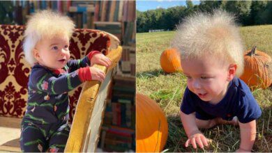 Síndrome do Cabelo Impenteável: conheça a anormalidade que atinge crianças