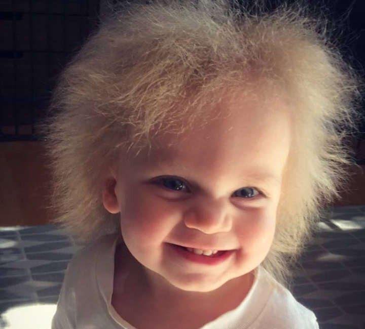 Síndrome do Cabelo Impenteável