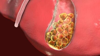 Tratamento para tirar pedras da vesícula e do fígado