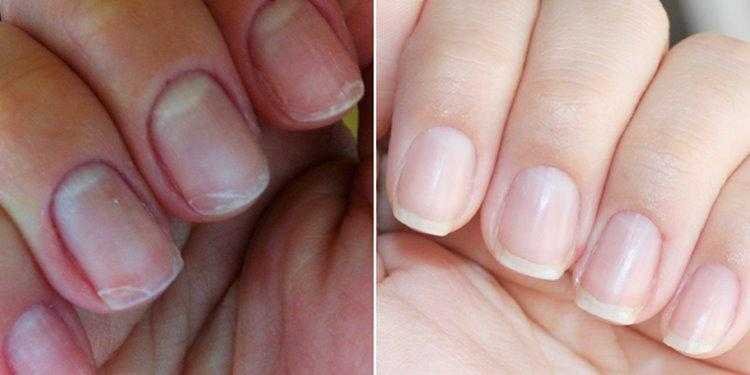 Tratamentos caseiros para fortalecer as unhas