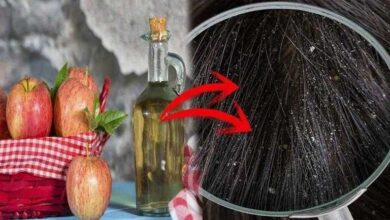 aprenda a controlar a caspa usando vinagre Aprenda a controlar a caspa usando vinagre