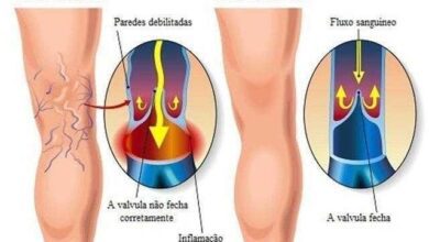 aprenda eliminar veias estouradas das pernas Aprenda ELIMINAR veias estouradas das pernas