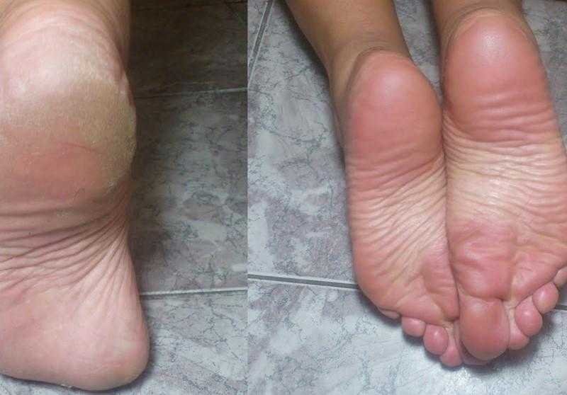 Aprenda tratar os pés rachados com repolho