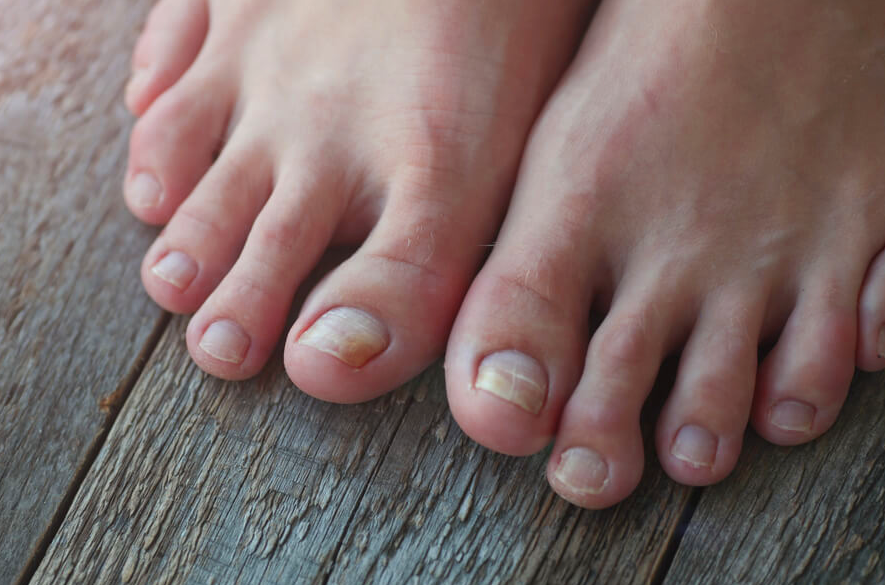 como eliminar fungos nas unhas dos pes e maos como eliminar fungos nas unhas dos pés e mãos