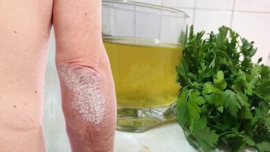 Como usar a salsa e mais 3 remédios caseiros para controlar a psoríase