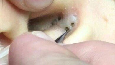 cravos sao retirados de dentro da orelha de mulher Cravos são retirados de dentro da orelha de mulher