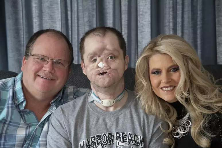 Homem realiza transplante de rosto que durou 50 horas após tentar tirar a própria vida; veja antes e depois
