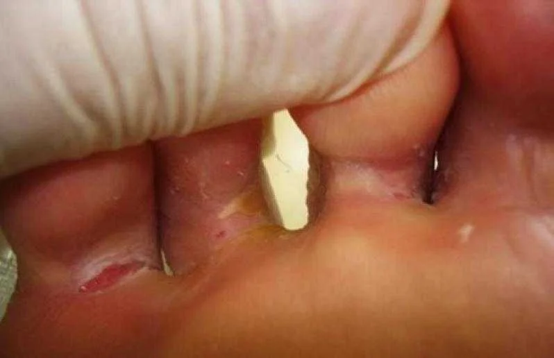 Elimine as frieiras com remédios caseiros