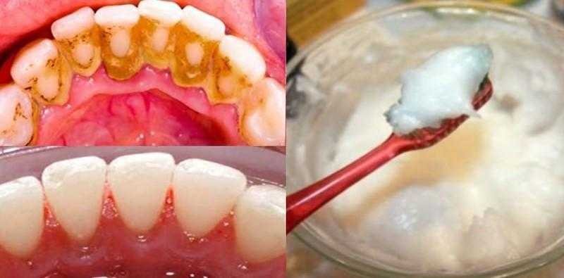 elimine o tartaro e a placa bacteriana com essa receita Elimine o tártaro e a placa bacteriana com essa receita caseira