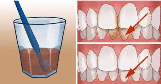 este remedio vai te ajudar a se livrar de manchas Este remédio vai te ajudar a se livrar de manchas feias de tártaro de seus dentes