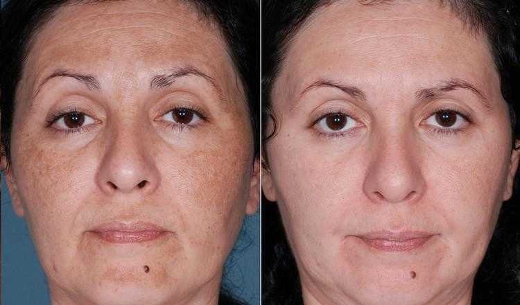 Máscara milagrosa para melasma e manchas no rosto