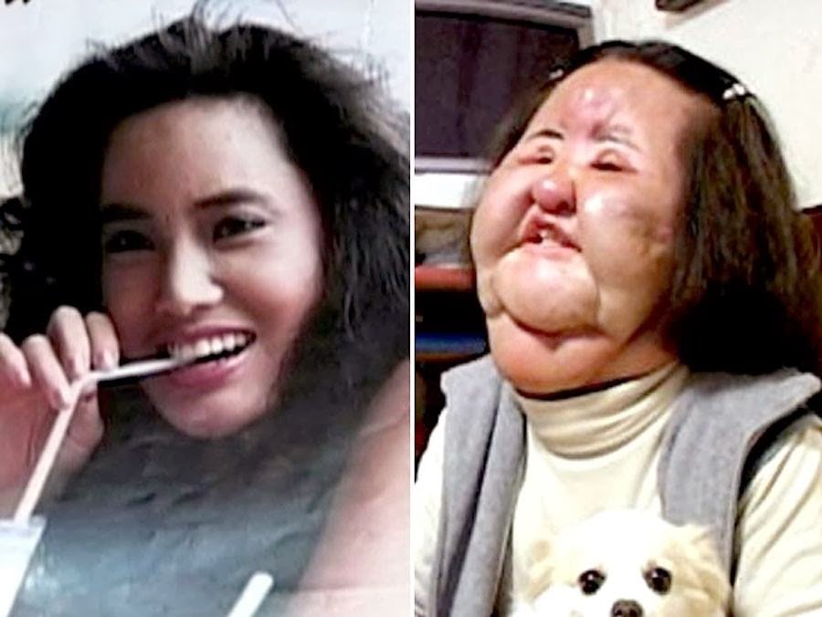 mulher injetou óleo de cozinha no rosto e o resultado foi monstruoso