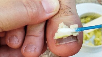 Os Melhores REMÉDIOS CASEIROS Para MICOSE DE UNHA!