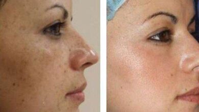 receita caseira para acabar com manchas no rosto rugas e Receita Caseira para acabar com Manchas no Rosto, Rugas e Melasmas