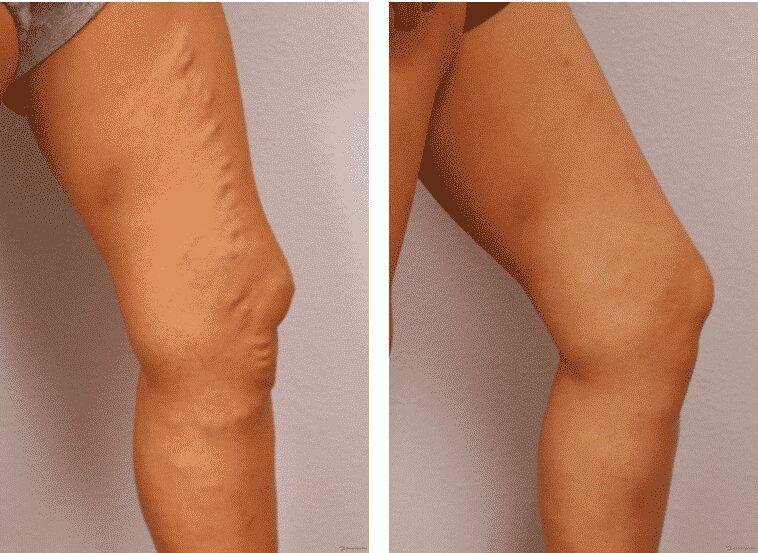 receita de babosa para curar varizes e reativar circulacao do Receita de babosa para curar varizes e reativar circulação do sangue