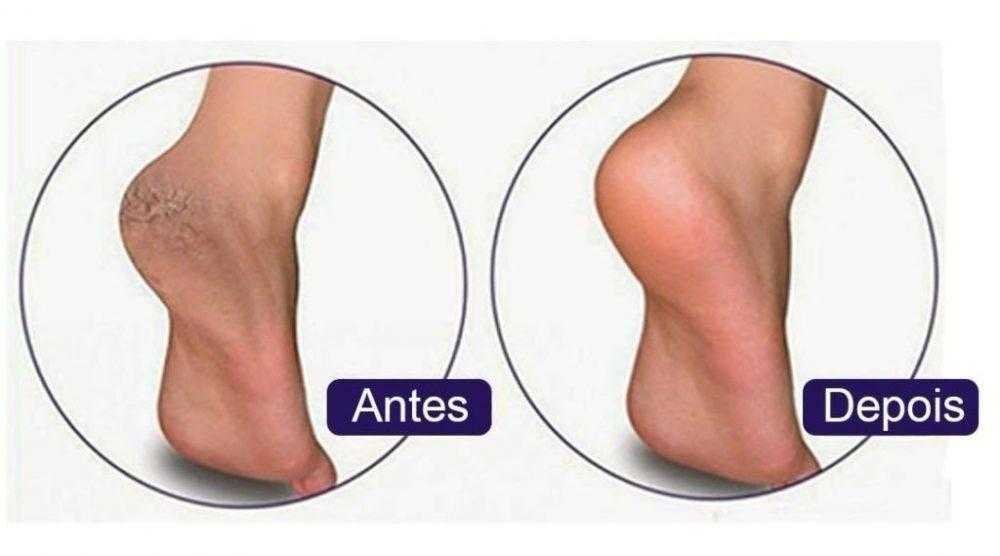 Receita para acabar com as rachaduras nos pés e mante-los macios