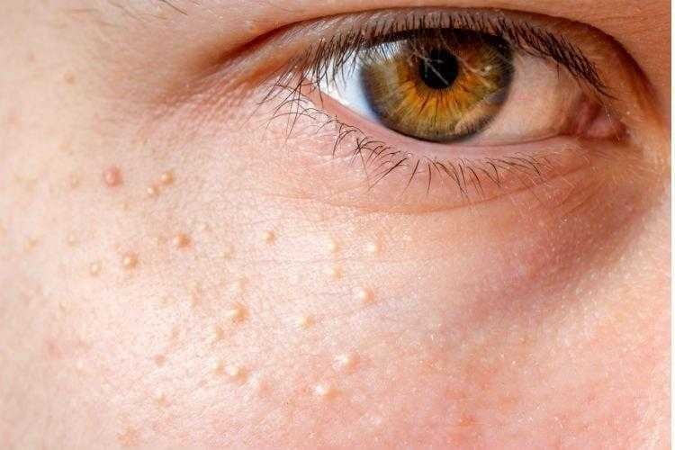 Sabe o que podem ser esses pontos brancos na cara rf