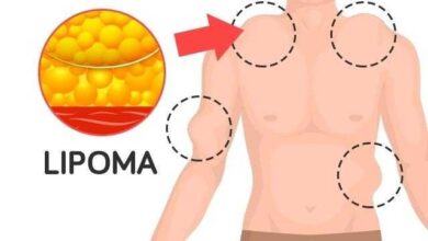 Saiba o que é Lipomatose f