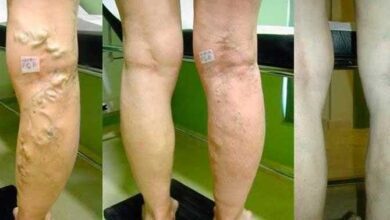 Tratamento caseiro para varizes | Bau das DICAS