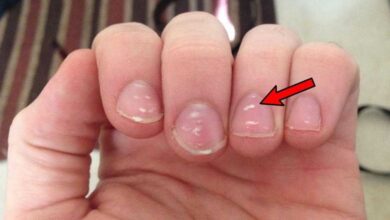 Sintomas de Niveis de Calcio Baixos O que acontece com