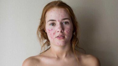 Tem mais de 25 e ainda tem espinha? Você pode estar com este problema