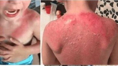 Pai faz alerta sobre o protetor da Peppa Pig que queimou completamente a pele de seu filho de 3 anos de idade