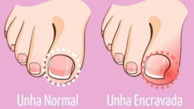 Como curar unhas encravadas