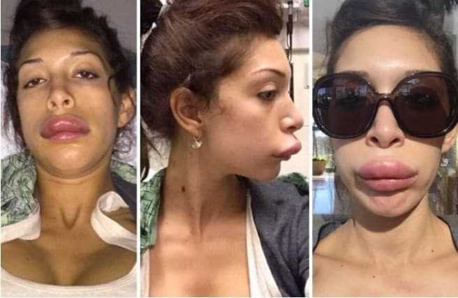 1751513129 206 atriz fez cirurgia para ter labios da angelina jolie mas Atriz fez cirurgia para ter labios da Angelina Jolie, mas ficou a cara da Leela do Futurama! d