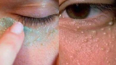 ELIMINE RAPIDAMENTE AS BOLINHAS AO REDOR DOS OLHOS