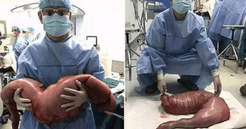 Cirurgião removeu isso de um homem que estava constipado há anos