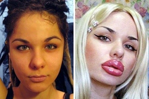 1502247948 671 veja as cirurgias plasticas que mais deram errado na historia humana