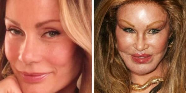 1502247948 728 veja as cirurgias plasticas que mais deram errado na historia humana