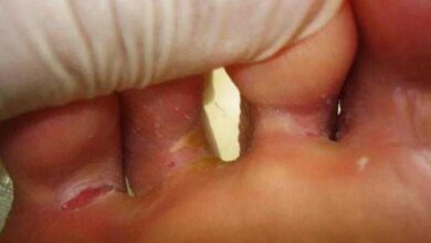 1751515045 aprenda como acabar com a frieira aprenda como acabar com a frieira 2