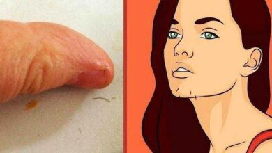 6 Causas do aparecimento de pelo no queixo das mulheres