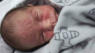 Bebê de 17 dias contrai herpes após beijo de visita