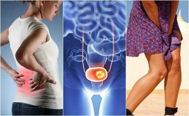 7 sinais de câncer de bexiga aos quais devemos ficar atentos 1q