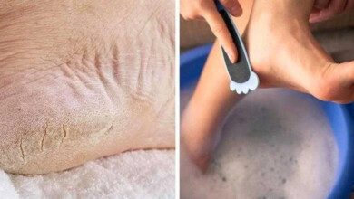 Remédios caseiros para pés secos e rachados fr