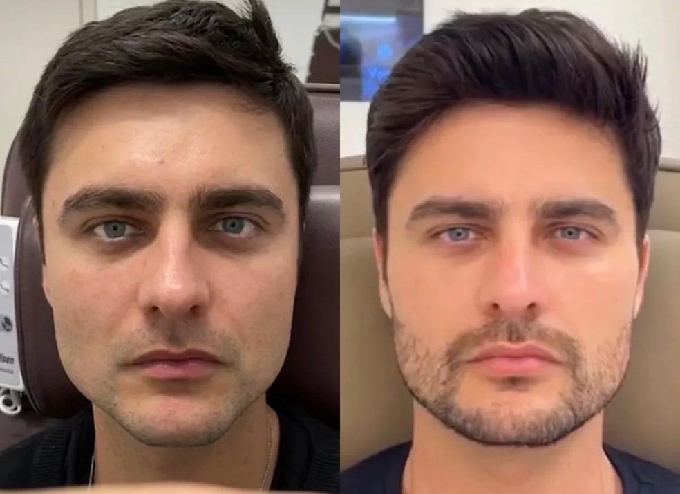 Guilherme Leicam em 2021, antes e depois de harmonização facial — Foto: Divulgação