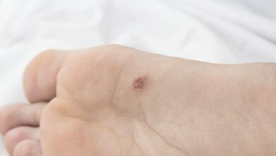 Como eliminar verruga e olho de peixe com água oxigenada