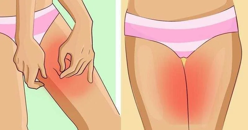 como evitar irritacoes nas coxas durante o verao Como evitar irritações nas coxas durante o verão tg