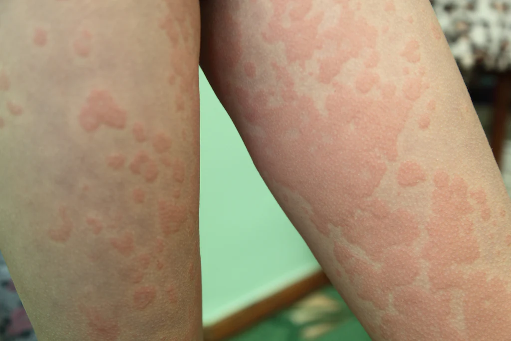 urticaria na pele