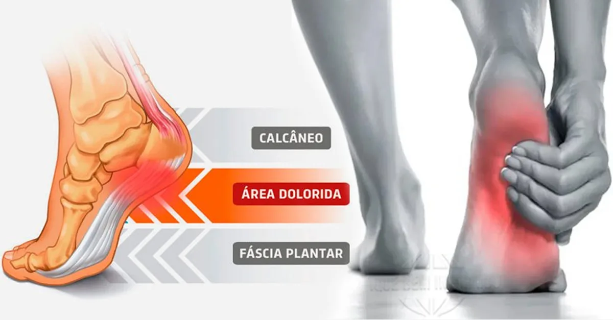 389 calcanhar com esporao elimine a desconfortavel dor com estas orientacoes 1 jpg