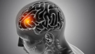 4 sinais de dor de cabeça que podem indicar um AVC.webp