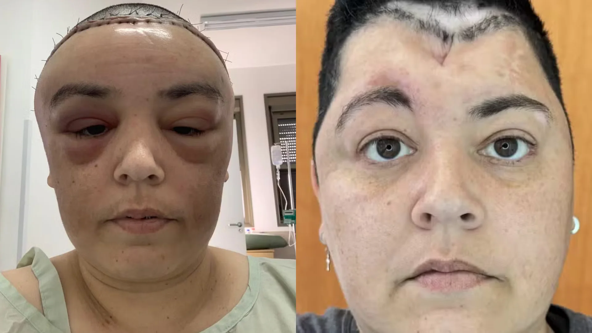 Mulher relata drama após diagnóstico raro: "Meu cérebro estava ‘vazando’ pelo meu nariz"