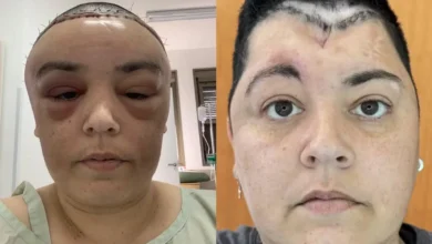 Mulher relata drama após diagnóstico raro: "Meu cérebro estava ‘vazando’ pelo meu nariz"